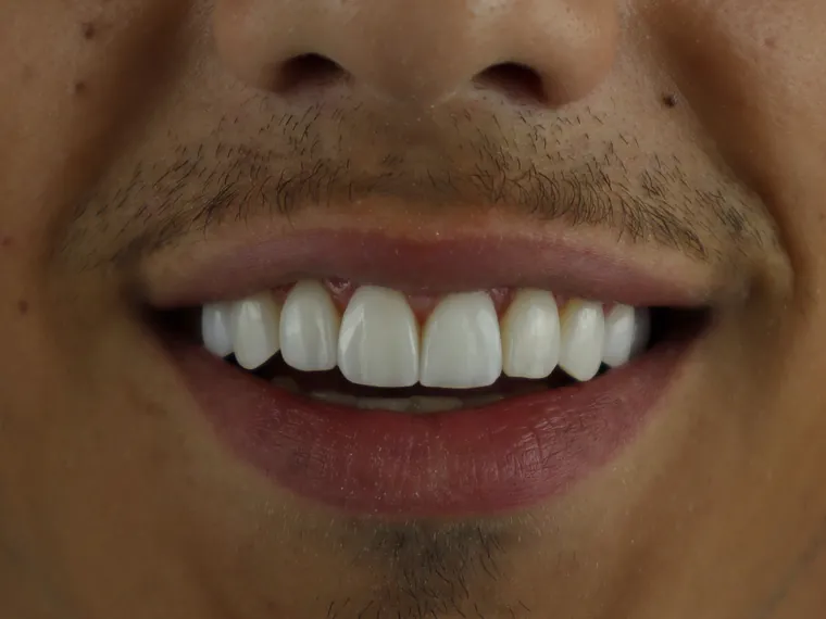 Sorriso do mesmo paciente depois do tratamento na Ferreira Lima Odontologia