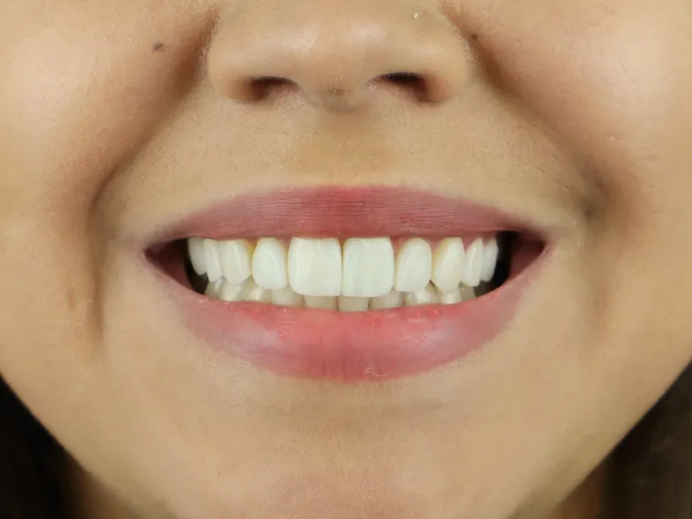 Sorriso do mesmo paciente depois do tratamento na Ferreira Lima Odontologia