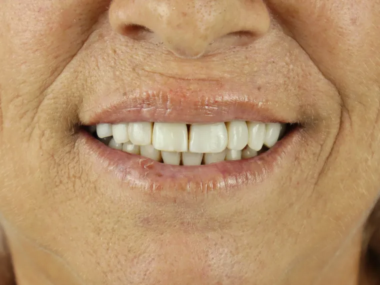 Sorriso do mesmo paciente depois do tratamento na Ferreira Lima Odontologia