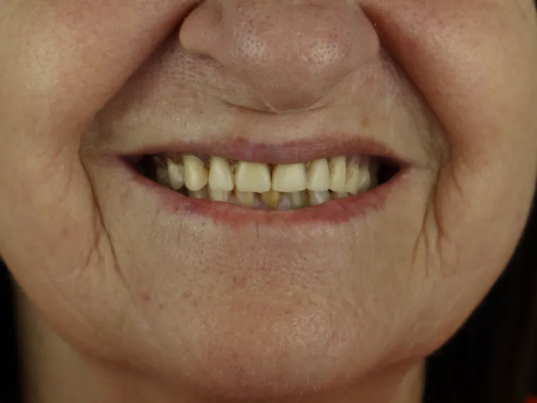 Sorriso do paciente antes do tratamento na Ferreira Lima Odontologia