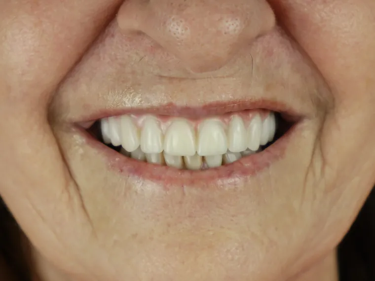 Sorriso do mesmo paciente depois do tratamento na Ferreira Lima Odontologia