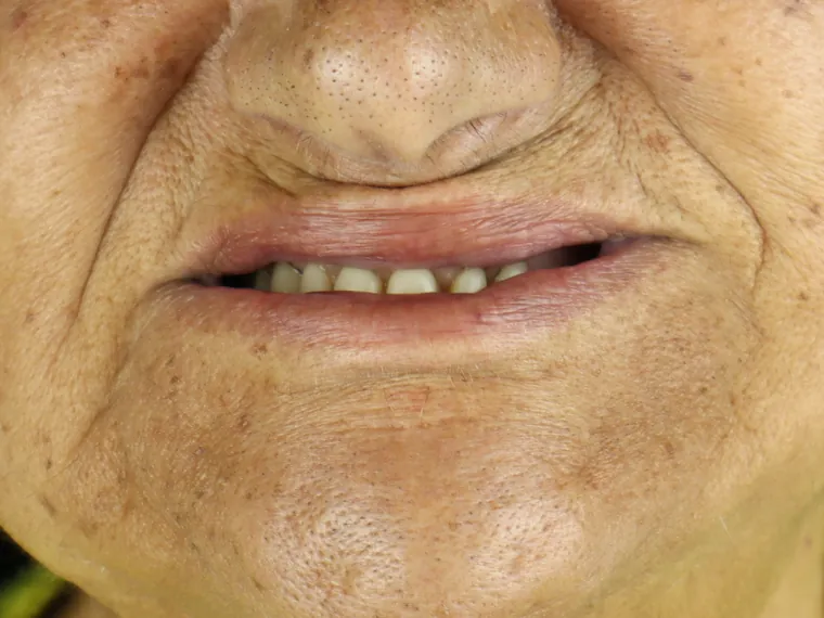 Sorriso do paciente antes do tratamento na Ferreira Lima Odontologia