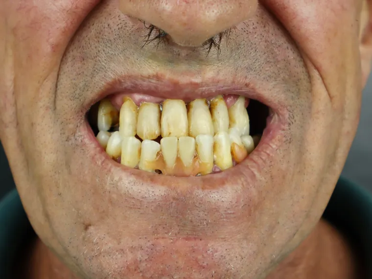 Sorriso do paciente antes do tratamento na Ferreira Lima Odontologia