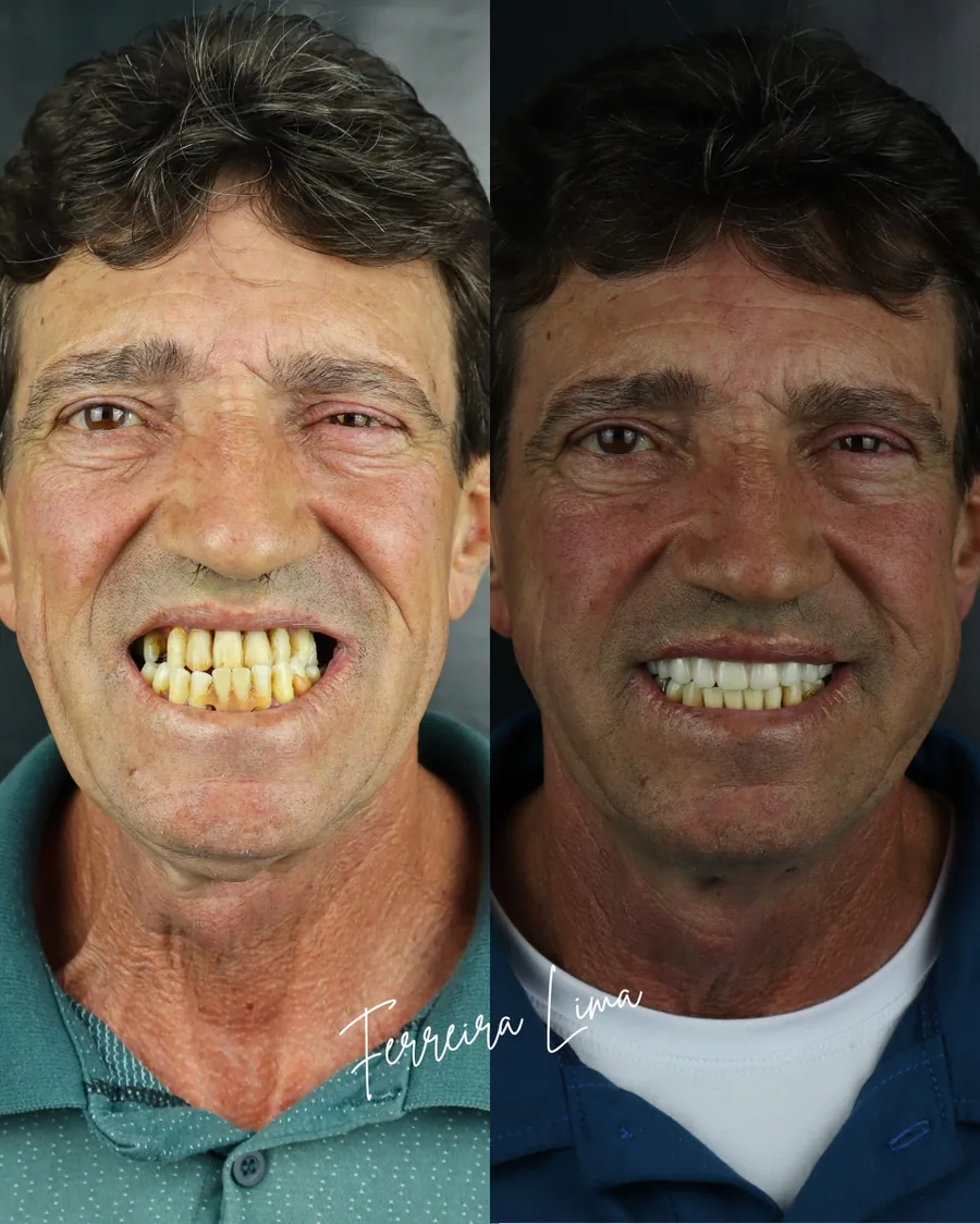 Protocolo superior com carga imediata: sorriso do paciente antes e depois do tratamento na Ferreira Lima Odontologia