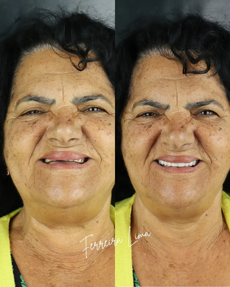 Próteses totais: sorriso do paciente antes e depois do tratamento na Ferreira Lima Odontologia