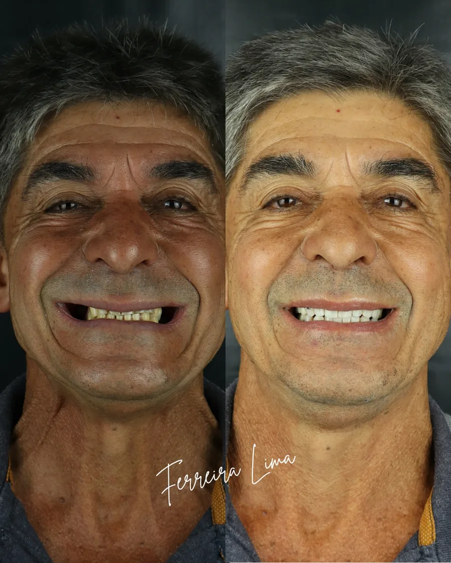Dimensão vertical de oclusão restabelecida: sorriso do paciente antes e depois do tratamento na Ferreira Lima Odontologia